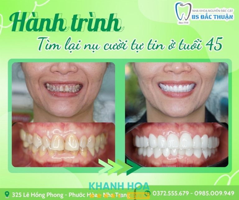 Nha Khoa Nguyễn Đắc Cật - Ekip BS Đắc Thuận - 325 Lê Hồng Phong