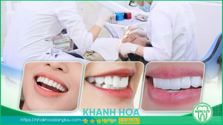 Quy trình bọc răng sứ thẩm mỹ tại Nha Khoa Đăng Lưu